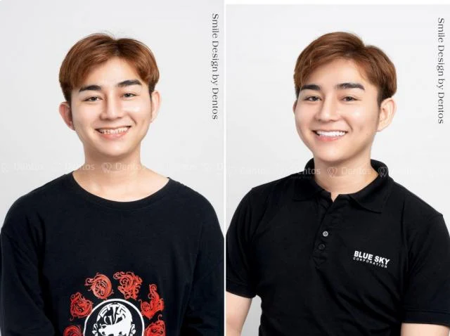 Bọc răng sứ không ảnh hưởng đến cấu trúc thiết kế